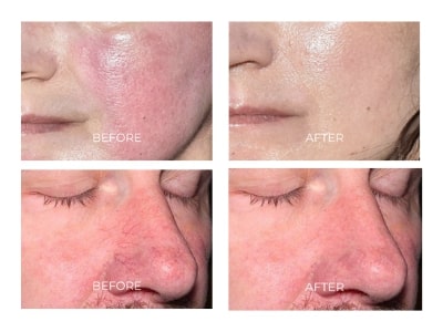 Résultats traitement rougeur visage laser 4